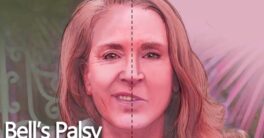 Bell’s Palsy