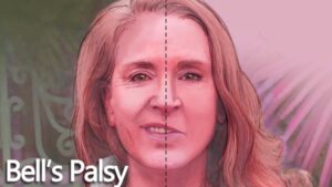 Bell’s Palsy